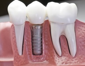 dental implants schaumburg il